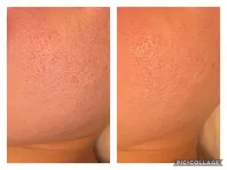 肌荒れ改善コース９０分｜8000円　しつこいニキビや繰り返しできるニキビでお悩みの方へ。根本的改善コース