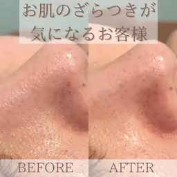 【モニター募集】ハイドラ✯毛穴洗浄とビタミン導入☆通常8,500円▶︎7,200円