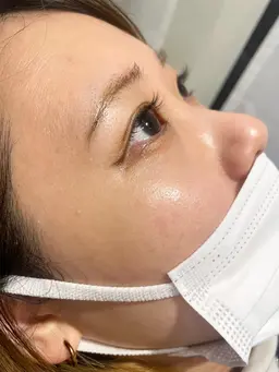 角栓毛穴洗浄💧(鼻または鼻周り周辺)+ソフトピーリング✨10代​〜​20代前半限定☆施術は男性が担当します！