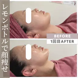 【フェイシャル痩身】RFリフト×小顔矯正 × デコルテリンパ× 脂肪撃退美容液 🍋 ¥13,800-