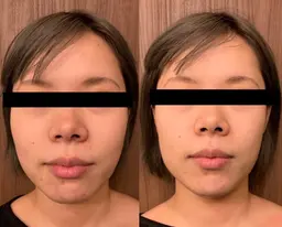 【U25/口コミと写真】小顔矯正