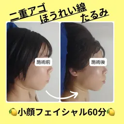 【大人気】韓国発🇰🇷美容液導入🍋小顔フェイシャル60分