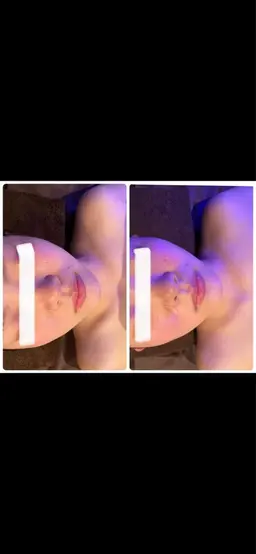 初回から効果が分かる痩身エステ☆お顔