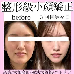 小顔認定サロンの小顔矯正リフトフェイシャルでスッキリ小顔に変化！