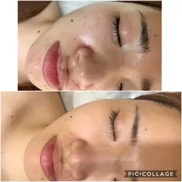 脱毛とフェイシャルのいいとこどり✨パーフェクト美顔脱毛☆ピーリング＆フォト効果＆美白パックでつるつる美肌😧