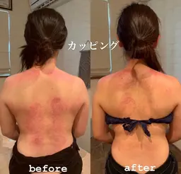 カッピング  今だけの料金‼️