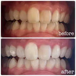 ✨ホワイトニング✨ナチュラルホワイトニング8分×5照射🦷🪥