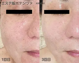 💎【凸凹跡・ニキビ跡・毛穴ケア】最新美容導入でつるん肌へ