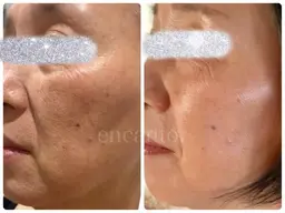 整形級スキンケア体験