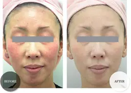 new 美白•黒ずみに《復元トリートメント》初回価格　過去の記憶を蘇らせ復元。(エイジング シミ シワ たるみ むくみ)