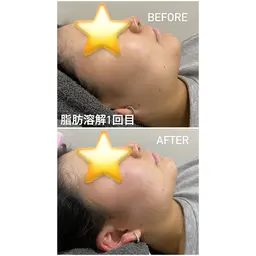 【男女】寝てるだけで一回り小さくなる⁉️脂肪除去 顔(5ml)