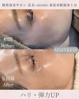 【新規】皮むけ乾燥/敏感肌/花粉/アレルギー等にお悩みの方に!乳酸ピーリング1回🥣小鼻毛穴洗浄込み✨️