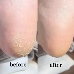 フットケア[フットバス・フットシャンプー付]