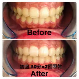 ホワイトニング回数券購入の方