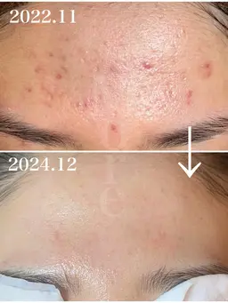 （ご新規様）人気No.2 毛穴×幹細胞ハーブピーリング　90分