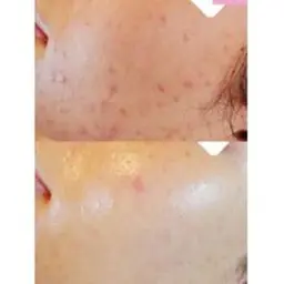 話題の乳酸ピーリング💄