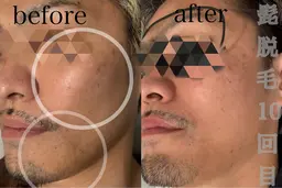 【メンズ髭脱毛】朝の時短&清潔感up!最新マシンで痛みに配慮◎¥6000