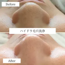 ハイドラ毛穴洗浄