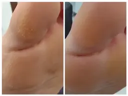フット🤎足裏角質ケア