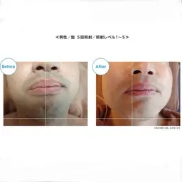 メンズ脱毛【ひげ全体】✨