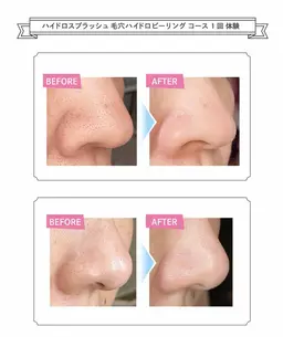 【徹底毛穴洗浄】   ハイドロ毛穴フェイシャル+デコルテケア ¥7000→¥6500