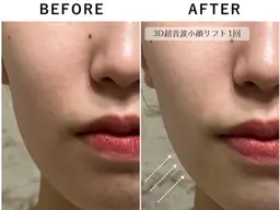 【3超音波3D小顔リフトアップ/全顔】輪郭スッキリ！その場で実感✨毛穴洗浄付き💕