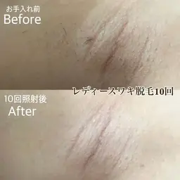 【ワンコイン】ワキ脱毛（レディース・メンズ）¥500