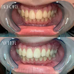 🌸3月限定🌸【セルフホワイトニング｜40分照射】歯を白くして笑顔に自信を✨¥4000→＼¥3700／