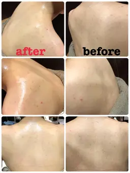 襟足✩肩から肩甲骨下辺りシェービング