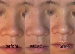 【オープン記念】韓国毛穴洗浄+プレミアスキンスチーマー+LED光フェイシャル