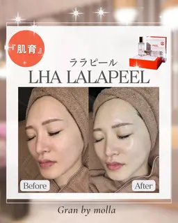 肌改善✨ダウンタイム無し！憧れの水光肌へ🫧🫧韓国美容​〜​ララピール​〜​¥12,800(通常)⇒¥9,800(初回限定)