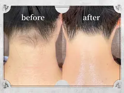 【新規/男女OK】うなじ脱毛/¥2000☆★30分