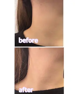 ⭐️12/27.30.1/13限定⭐️【サーマトリックス/オリジオ同様効果】リフトアップ&コラーゲン作成でしわ毛穴ケア