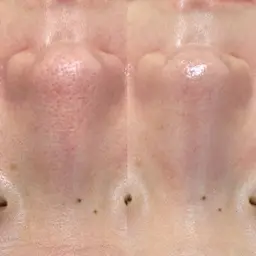 【新規】『鼻ピーリング』(小鼻の黒ずみ.毛穴ケアに◎】ハーブピーリング(鼻)