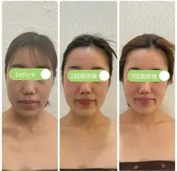 【新規】【平日限定】整形をお考えの前に!ダウンタイムのない整形級・頭蓋骨小顔矯正90分