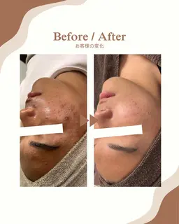 【ニキビケアコース】その場しのぎじゃない❗️本気のニキビケア🔥思春期ニキビ、大人ニキビにお悩みの方へ