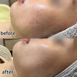 【最新機種アクアダーマ】頑固なニキビ肌ケアに　60分 ¥16500→¥8800