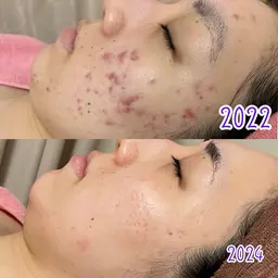 【剥離なし★角質ケア】ツヤ肌バクテリウムピール+フェイシャルケアー付き♥ダウンタイムなし （大阪/梅田）