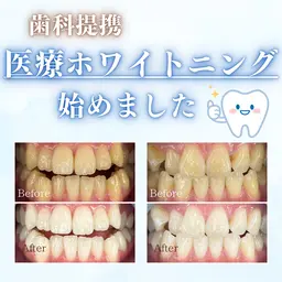 医療系セルフホワイトニング導入キャンペーン🦷✨8回チケット※別途ホワイトニングジェル代がかかります。