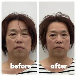 【エラ張り・頭痛】美容鍼×首肩こりマッサージ 　¥10,000→¥4,980