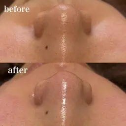 【ニキビ予防に👌🏻】お顔まるごと毛穴洗浄😶‍🌫️×インナーケアカウンセリング込み💫 口コミ価格🙇🏻‍♀️