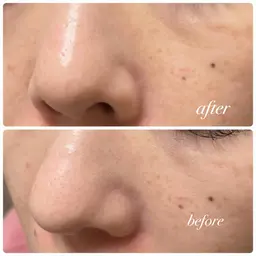 ミニモ限定【お試し】毛穴ディープクレンジング洗浄【浮き出す角栓】メンズ〇