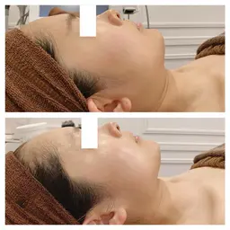 小顔ハイパーナイフEX