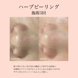 ミニモ限定価格【ニキビ/ザラつきにはこれ】ハーブピーリング