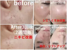 【都度払い】[・ニキビケア・シミくすみ改善・美肌リフトアップ]選べる肌質改善光フォト+ヒト幹パック¥6500→¥5000