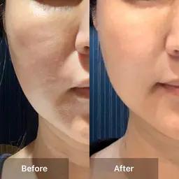 小顔・白肌効果フェイシャル3点セット【顔脱毛+角栓美肌クレンジング+デコルテまでのフェイシャルリンパ】