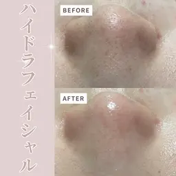 【26日来店限定💖】水素水ハイドラフェイシャルフルコース🫧パック付き🫶🏻