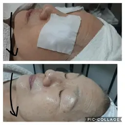 【リピートNo.1✨】小顔　美白　透明感　ヒアルロン酸たっぷりフェイシャルベーシックエステ