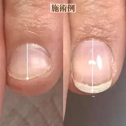 【噛み爪/トラブル爪/むしり癖】 深爪育成・美爪育成