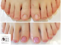 【深爪矯正★女性フット】お試し1回体験